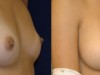 1b-breast-enlargement